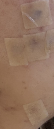 after photo: 여드름압출, 여드름주사