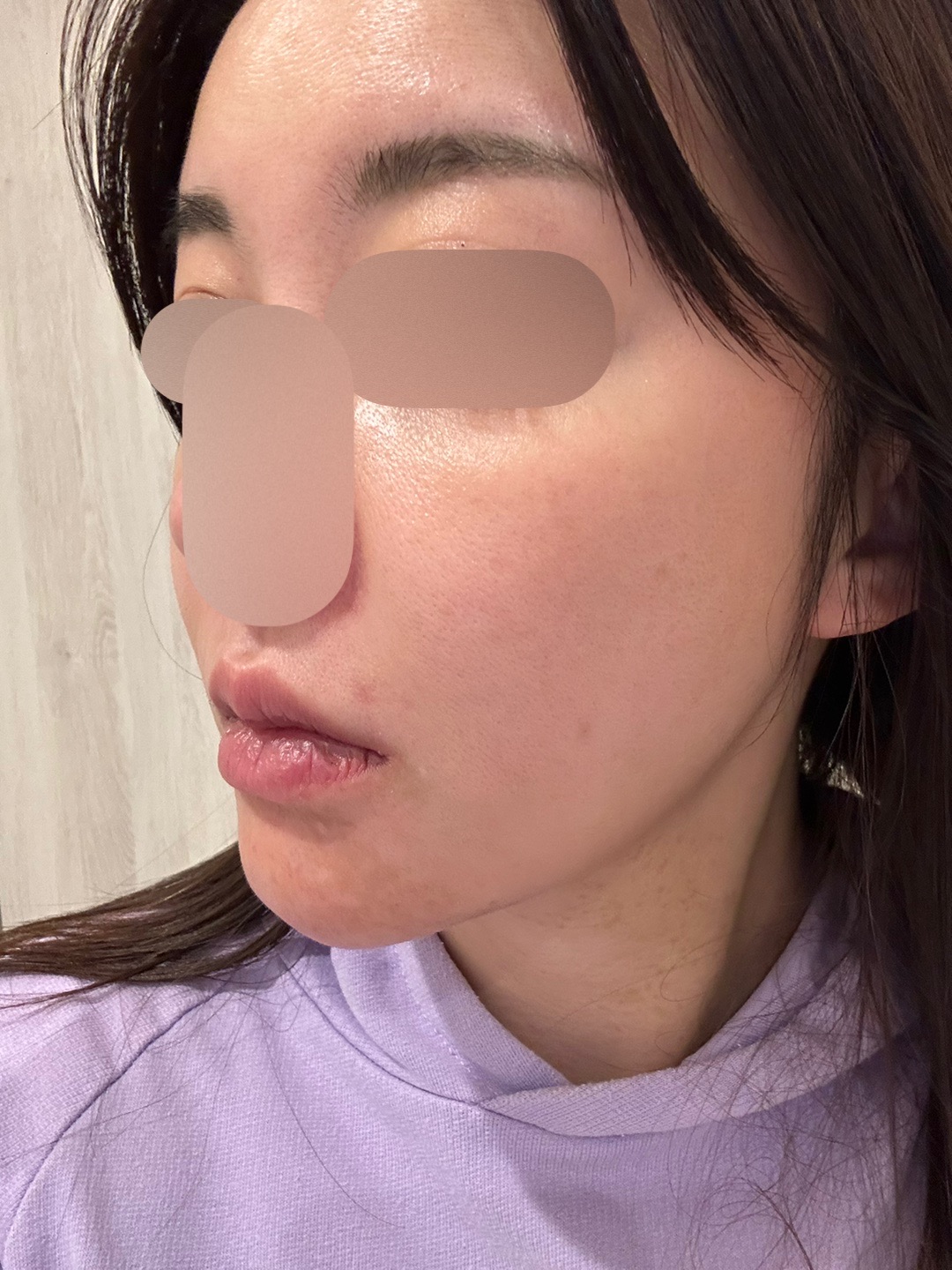 IPL（光治療）全顔2周 ｜ステラM22フォトフェイシャル【12月15日迄にご