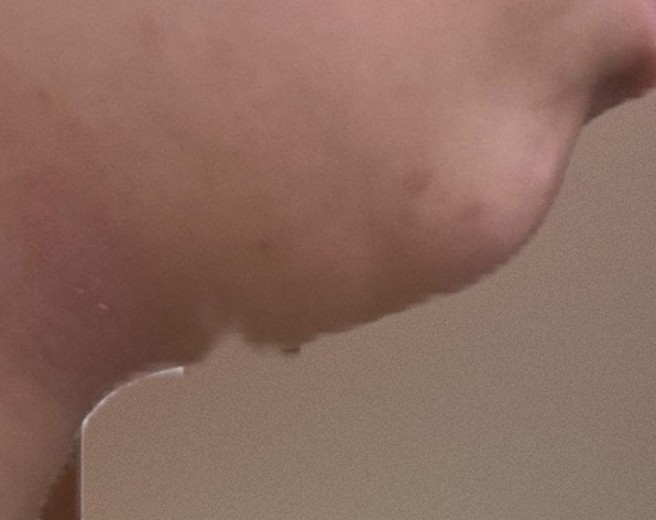 after photo: 脂肪溶解注射(顔)