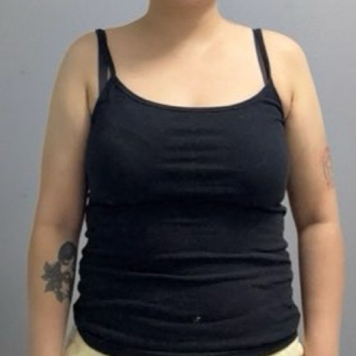 after photo: 脂肪溶解注射(腕)