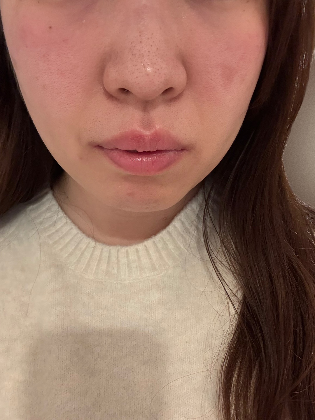 全顔シミ取り放題＋美顔レーザートーニング【12月29日迄にご予約頂いた