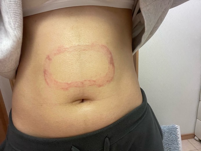 after photo: 脂肪冷却(腹部)