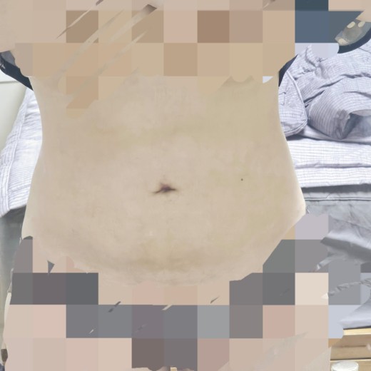 after photo: 러브핸들지방흡입, 복부지방흡입