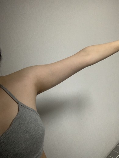 after photo: 팔지방분해주사