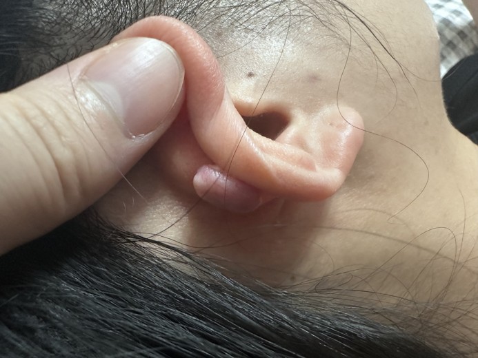 before photo: 캘로이드귀성형