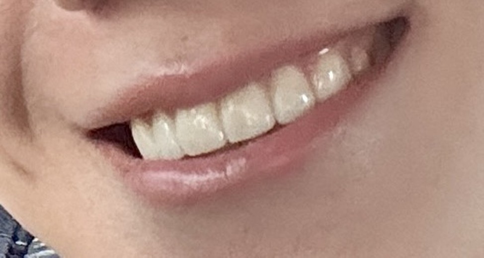 after photo: 라미네이트