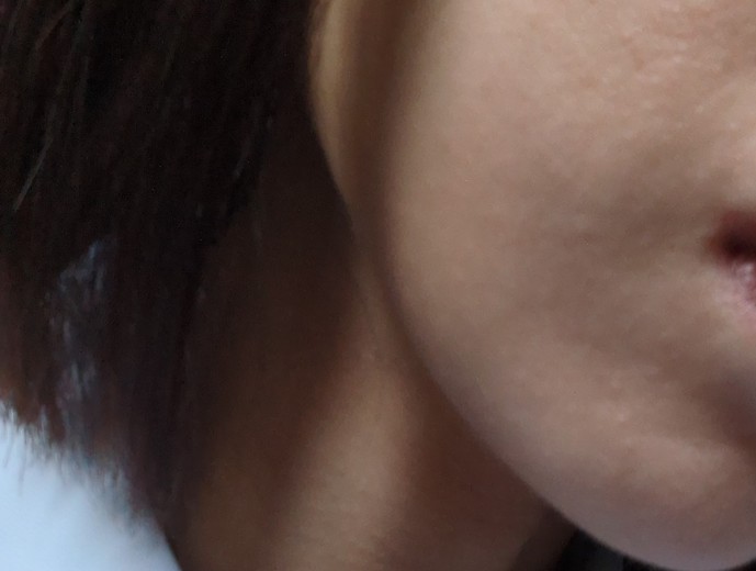 after photo: 糸リフト, メーラー/ジョール/バッカルファット除去
