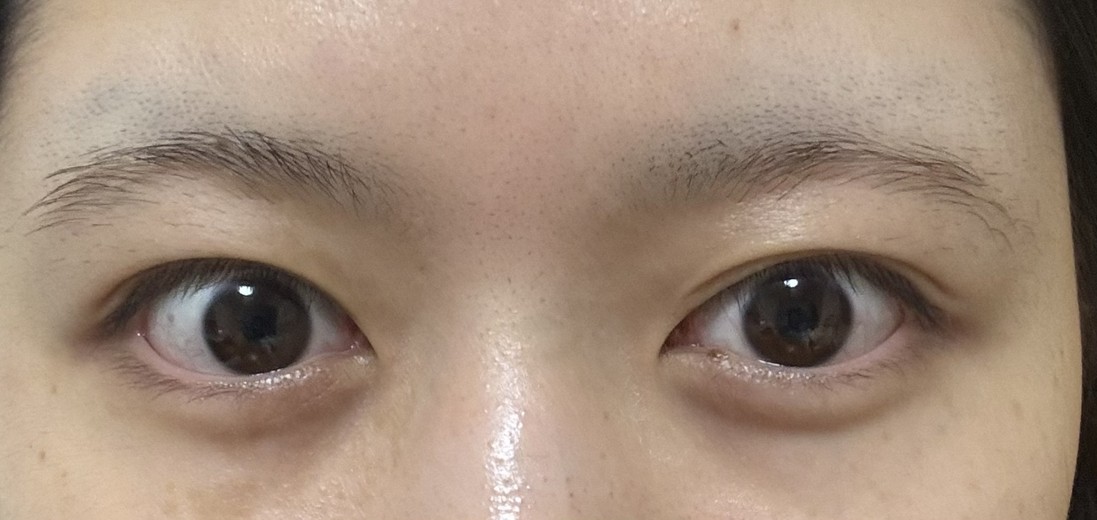 after photo: 目の下脂肪再配置(ハムラ・裏ハムラ法)