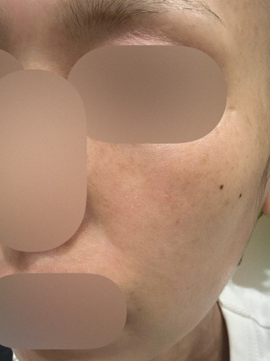 before photo: エレクトロポレーション