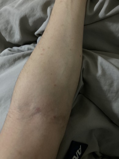 after photo: エクソソーム, 美容注射・点滴