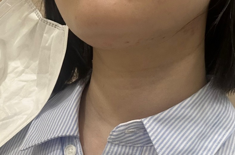 after photo: 윤곽주사