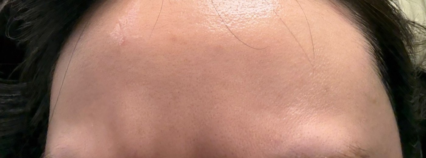 before photo: 턱끝보톡스, 미간보톡스, 눈가주름보톡스