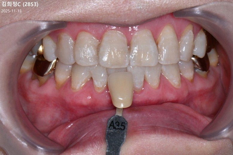 after photo: 치아미백