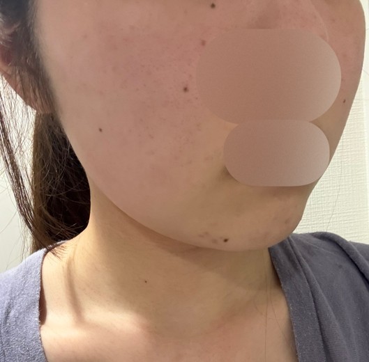 after photo: ピーリング