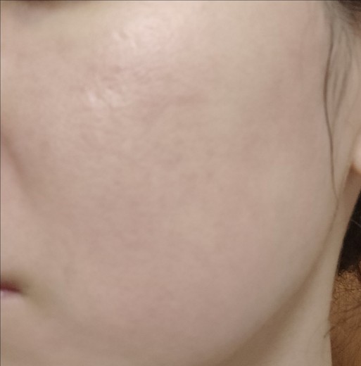 before photo: エレクトロポレーション
