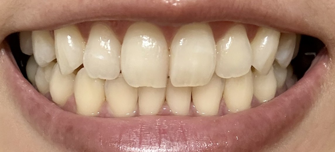 after photo: ホワイトニング