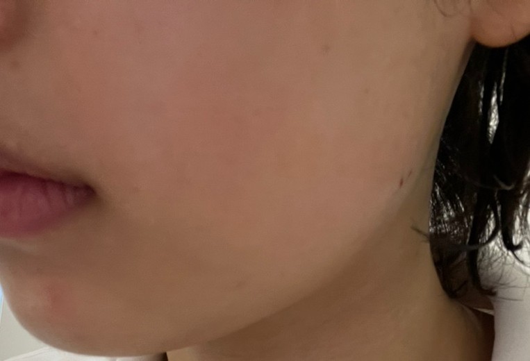 after photo: 사각턱보톡스, 튠라이너