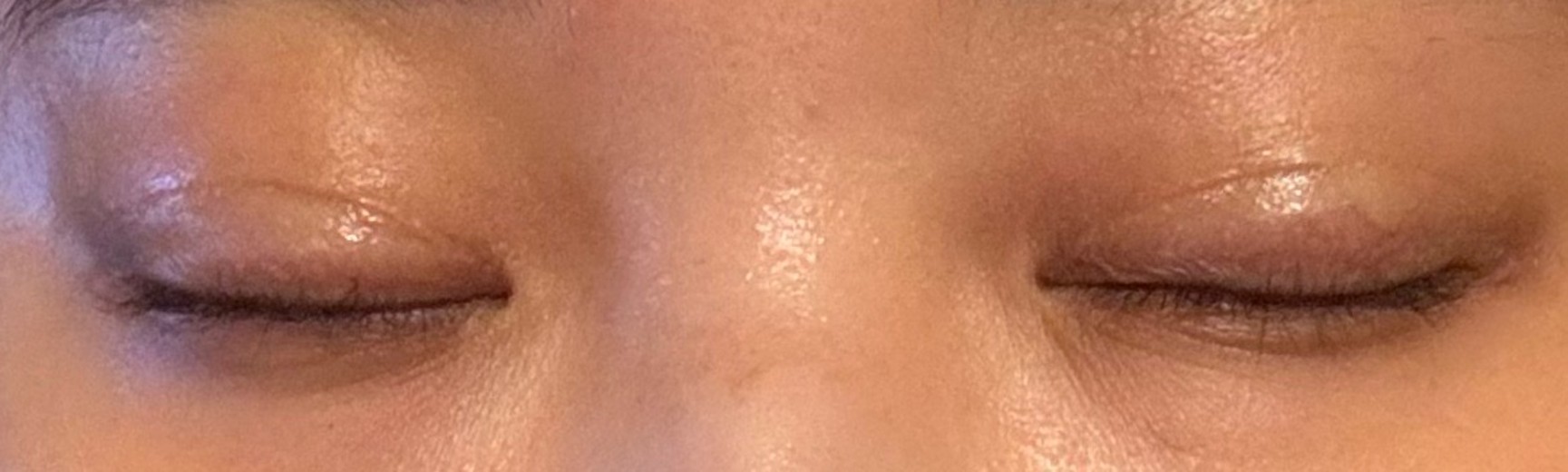 before photo: 눈재수술, 눈매교정