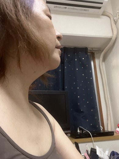 before photo: 脂肪溶解注射(顔)