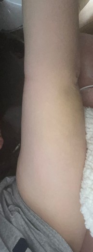after photo: 脂肪吸引(腕)