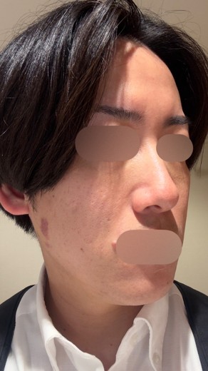 after photo: ポテンツァ(POTENZA)