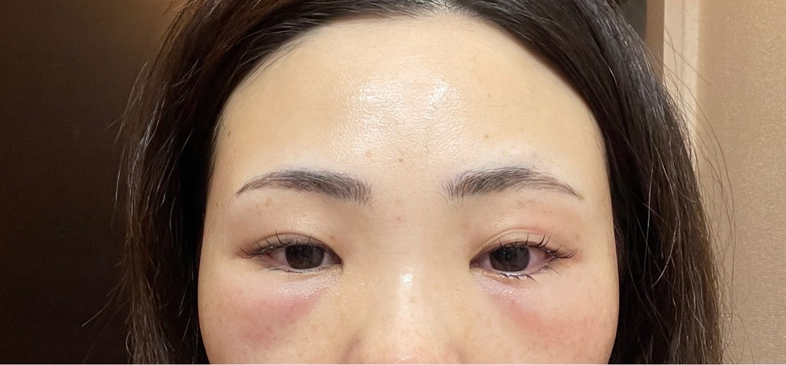 after photo: 脱脂(クマ治療)
