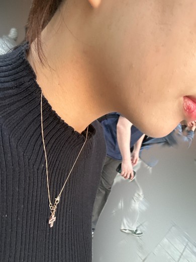 after photo: 침샘보톡스