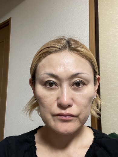 before photo: マッサージピール(コラーゲンピール)