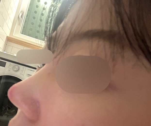 after photo: 콧대(보형물), 코끝(자가연골)