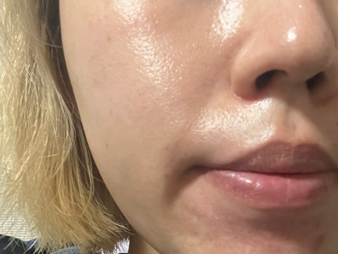 after photo: ピーリング, ルメッカ