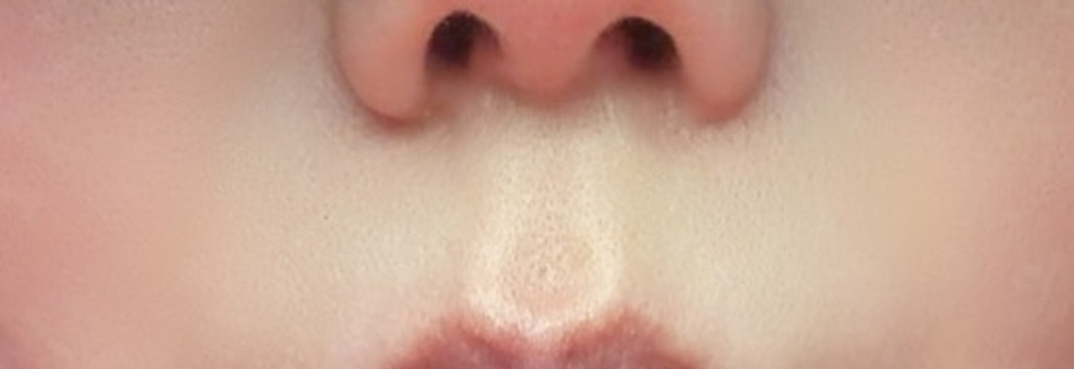 after photo: 실리프팅, 팔자주름필러