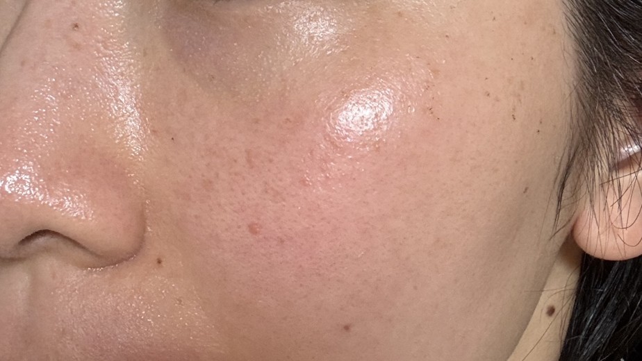 after photo: IPL(光/フォト治療)