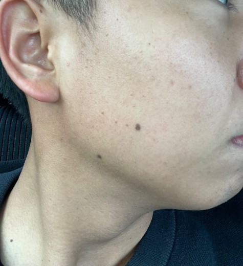before photo: ダーマペン