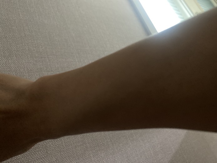 before photo: 팔제모, 종아리제모, 아포지레이저