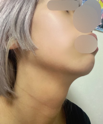 after photo: 首・広頚筋ボトックス