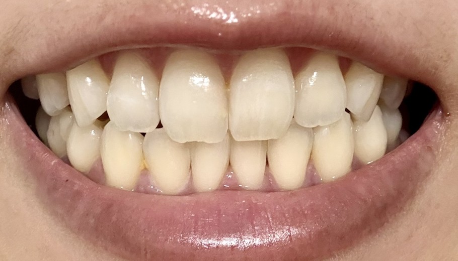 after photo: ホワイトニング