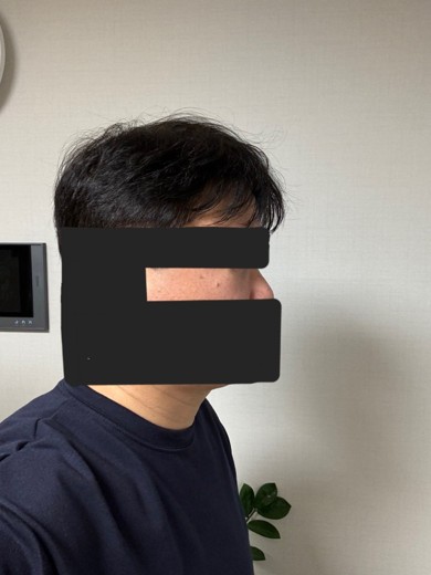 after photo: 눈밑지방재배치