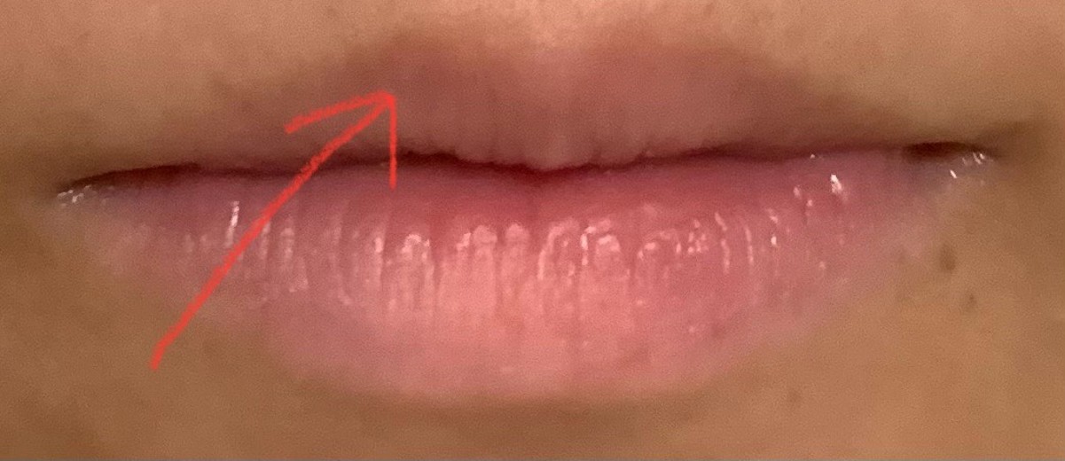 after photo: IPL(光/フォト治療), ルメッカ