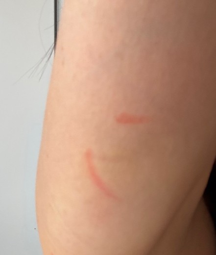 after photo: 脂肪溶解注射(肩)