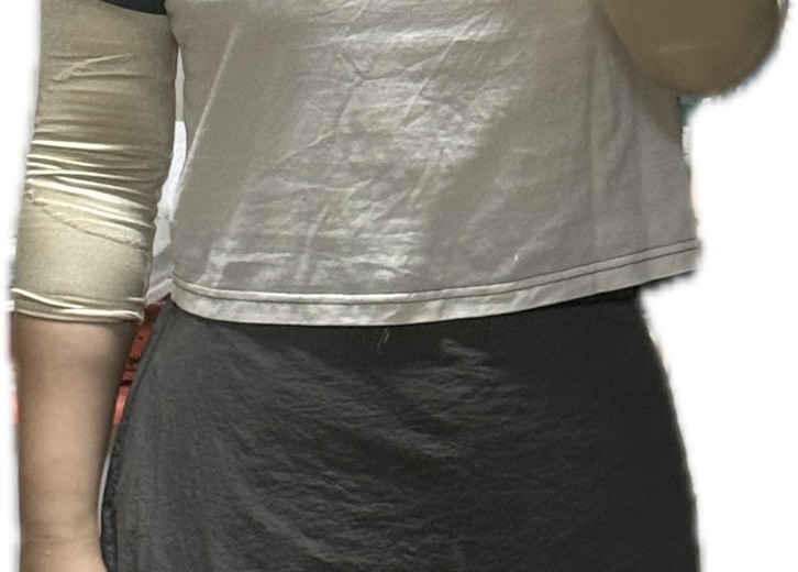 after photo: 팔지방흡입, 옆구리지방흡입, 복부지방흡입, 허리지방흡입