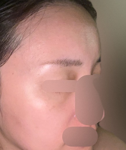 before photo: ヴェルベットスキン
