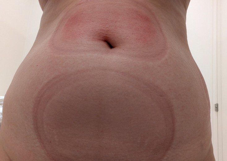 after photo: 脂肪冷却(腕), 脂肪冷却(腹部)