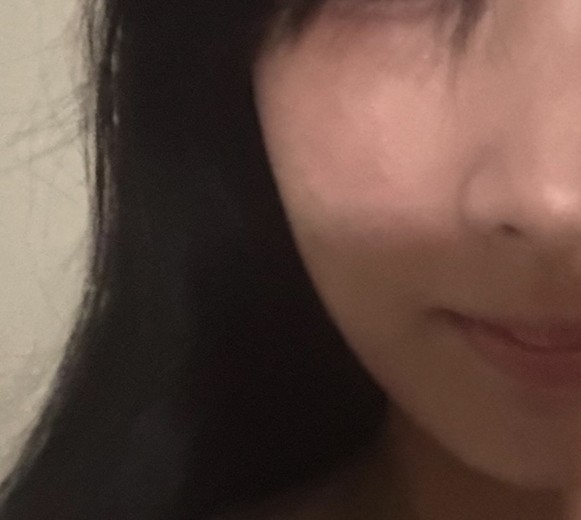 after photo: ハイフ(HIFU)