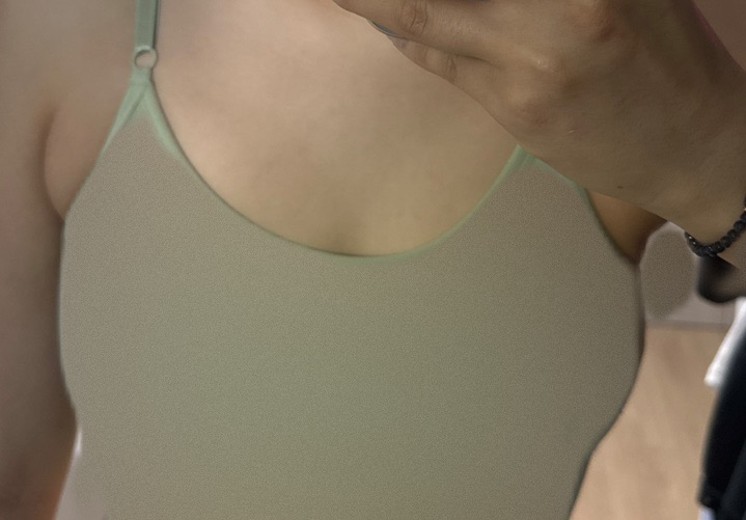 after photo: 가슴보형물제거