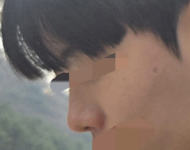 before photo: 비중격만곡증수술