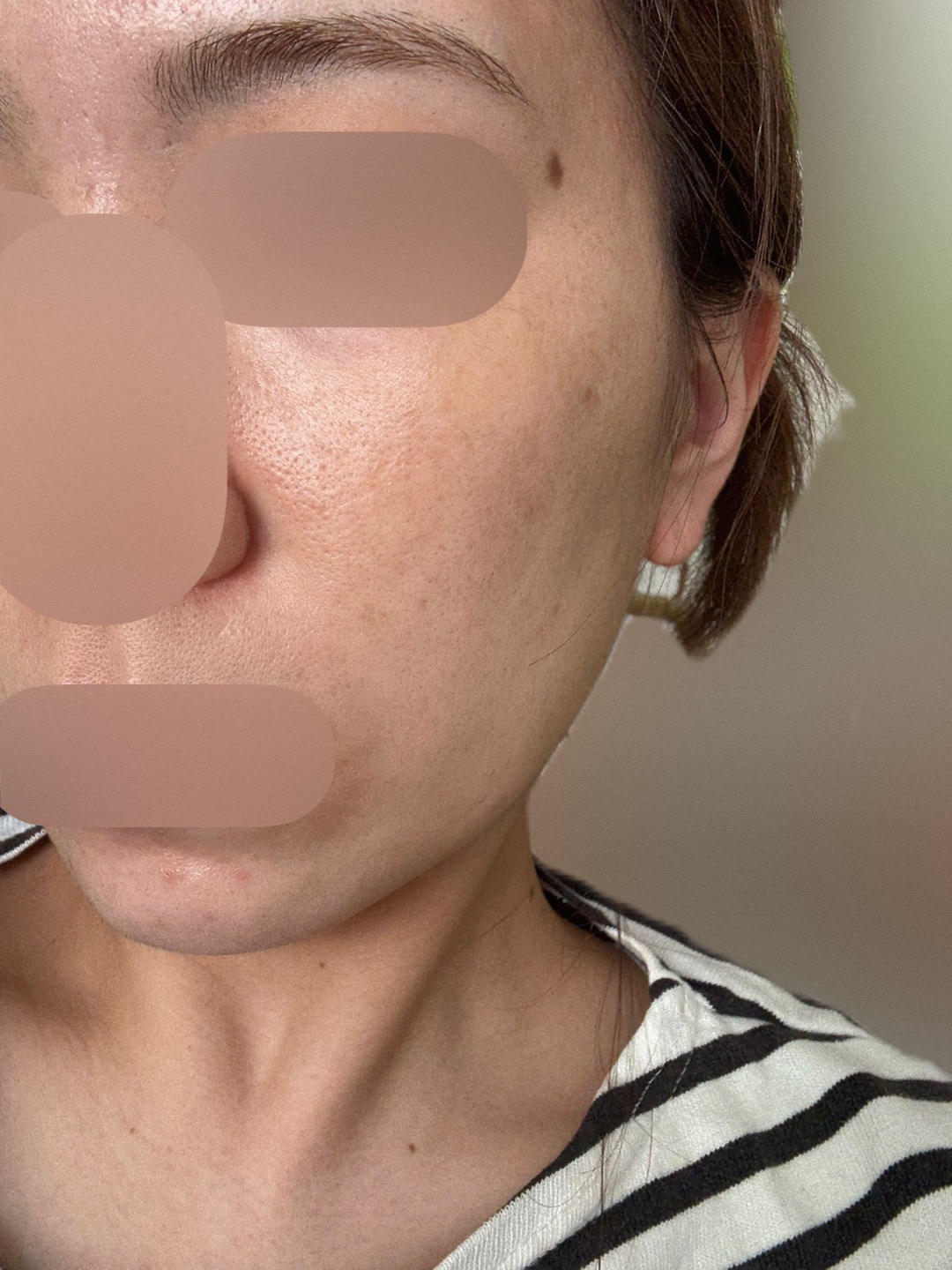 IPL（光治療）全顔2周 ｜ステラM22フォトフェイシャル【11月15日迄にご