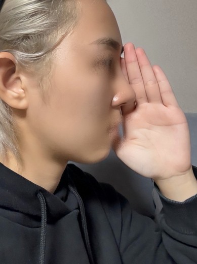 after photo: 콧대(보형물), 코끝(자가연골), 복코교정(수술)