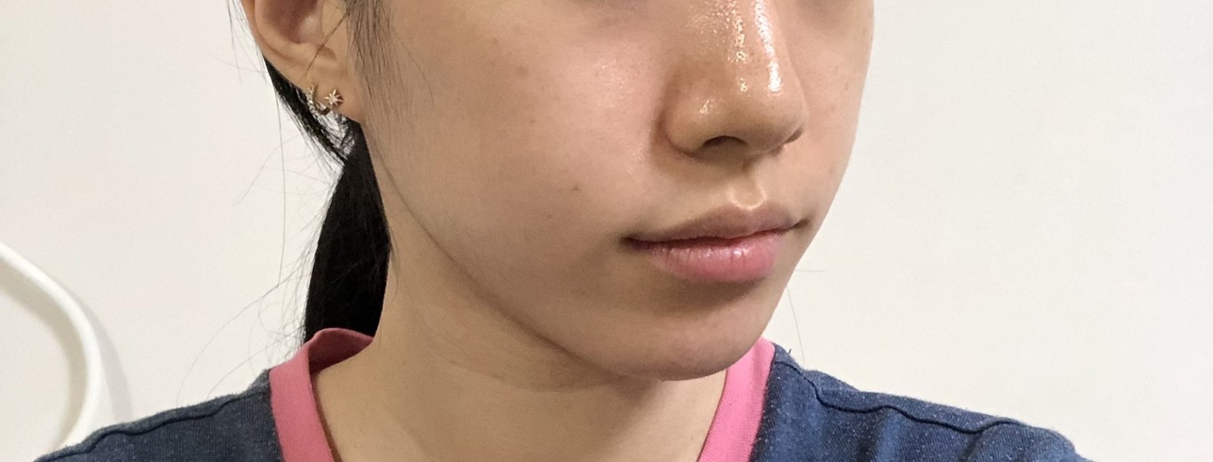 after photo: 입꼬리필러, 입술필러