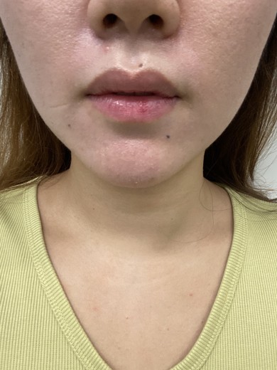 before photo: 슈링크리프팅