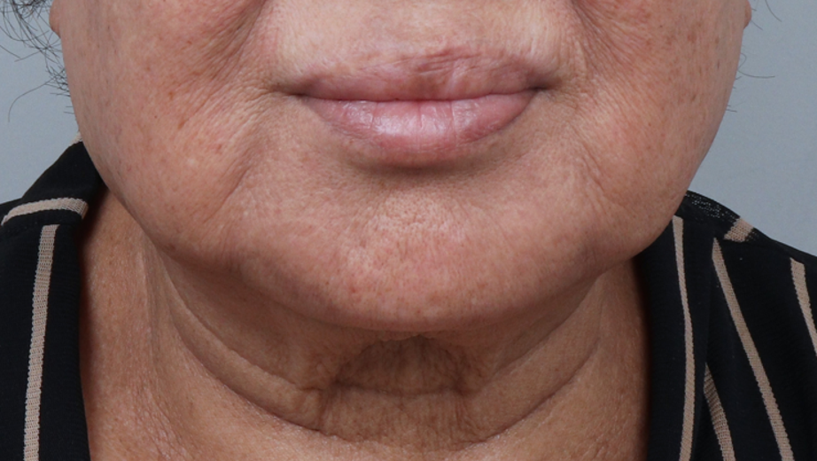 before photo: 실리프팅